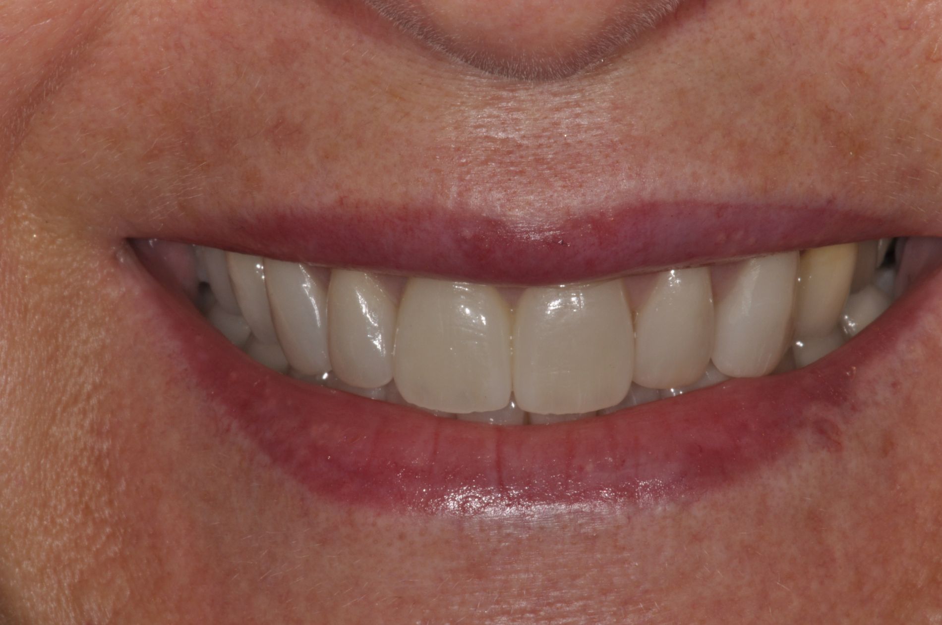 Keramische Veneers und Kronen